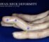 Swan Neck Deformity